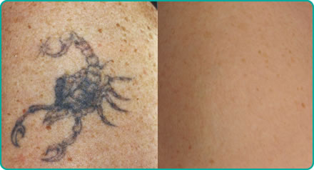Single colour tattoo removal before (left) after (right)